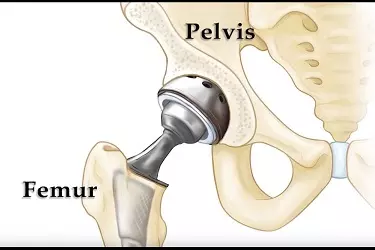 Best Hip Replacement Surgeon in India, Best Hospital For Hip Replacement Surgery In India , Best Doctor For Hip Replacement Surgery In India, Cost Of Hip Replacement Surgery In India , Hip Fracture Surgery in India
